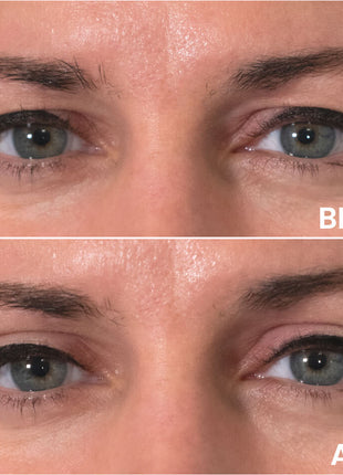 Instantly Lift Your Eyelids for a Youthful Look